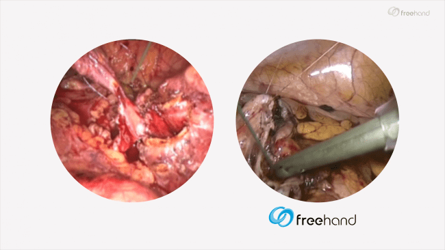 Comparison of handheld vs robotic view through laparoscope during surgery