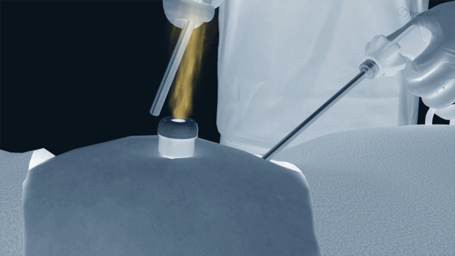 aerosol release through port after laparoscope is removed for cleaning